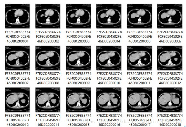 MicroDicom viewer(Dicom格式看图软件)